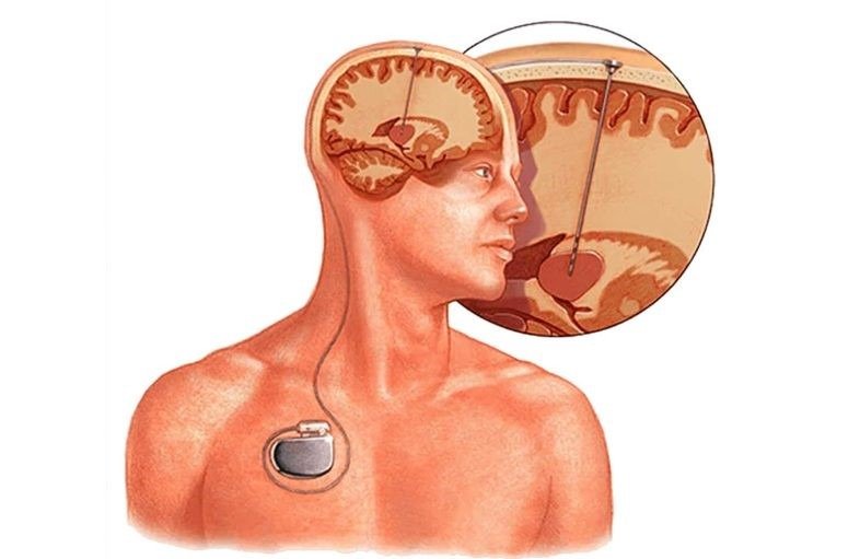 What is the functional neurosurgery?