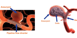Brain aneurysm treatment at Dr Rao's Coiling and flow diverter