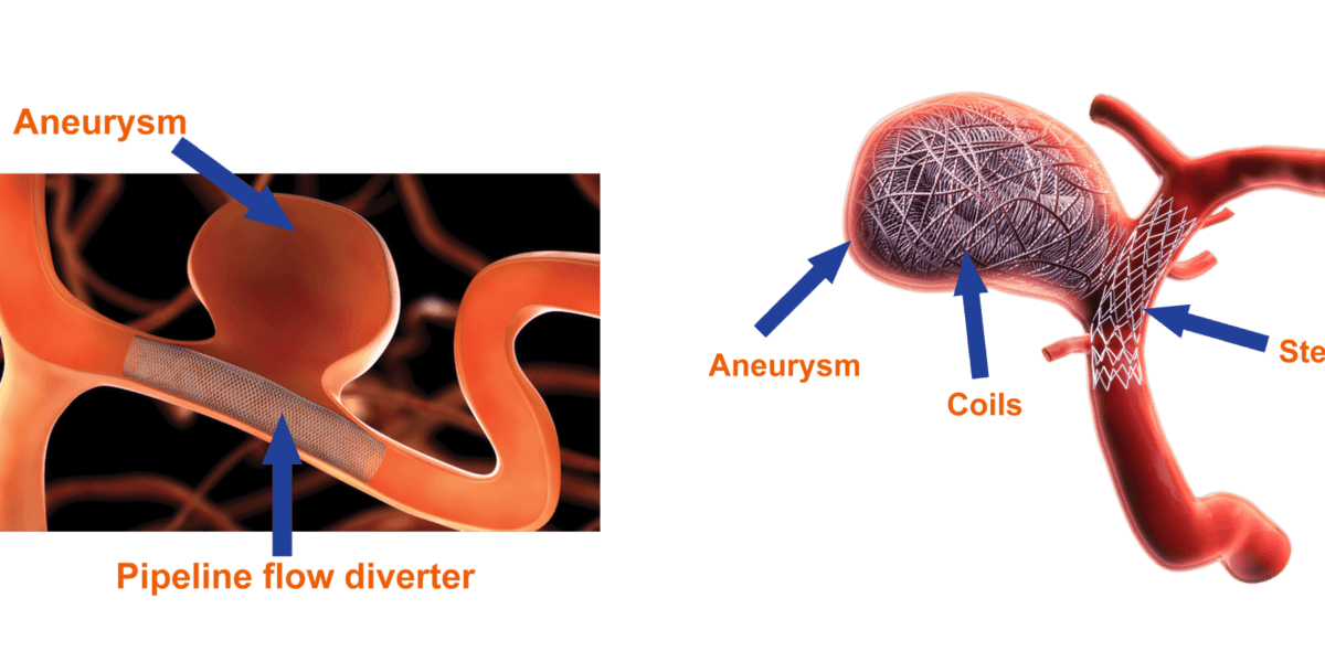 Brain aneurysm treatment at Dr Rao's Coiling and flow diverter