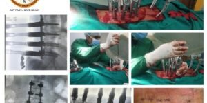 Advanced neurosurgery performed using minimally invasive techniques at Dr. Rao’s Hospital in GunturFusion