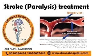 Comprehensive mechanical thrombectomy stroke Neurosurgery Hospital Services - Dr. Rao at Dr. Rao's Hospital