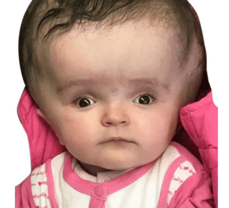 Paediatric Neurologist Near Me - Dr. Rao at Dr. Rao's Hospital Hydrocephalus
