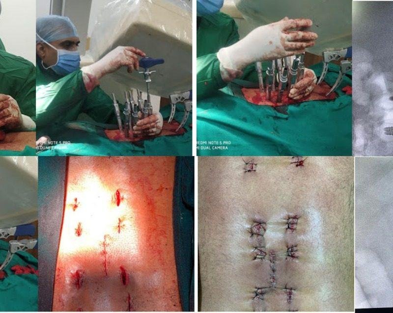Exploring Advanced Techniques in Spine Surgery: Dr. Rao at Dr. Rao's Hospital