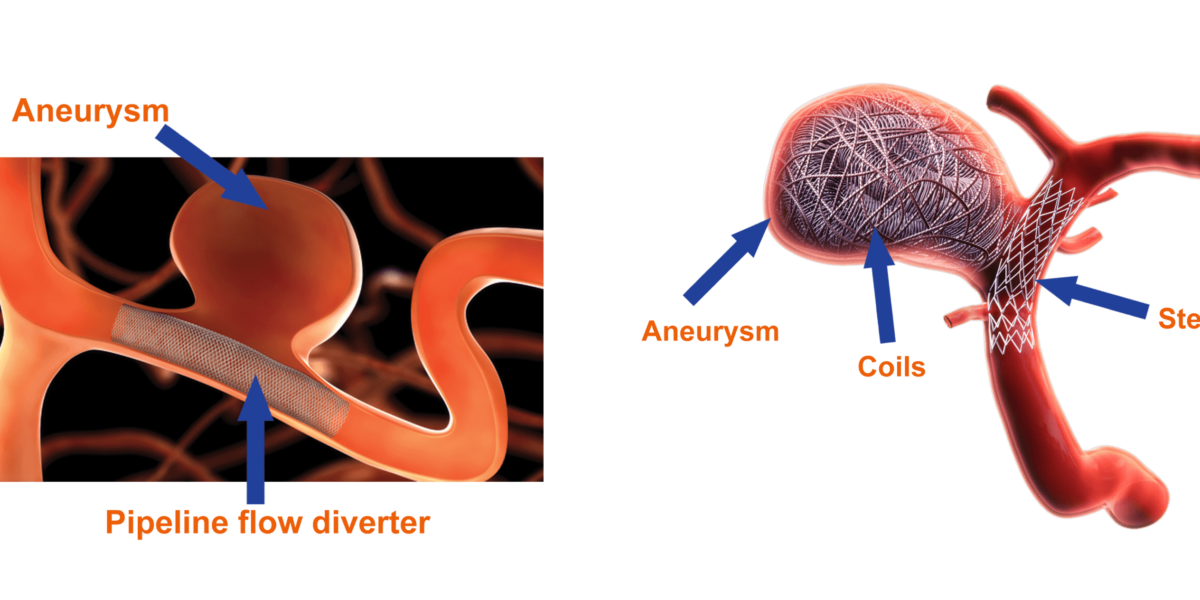 Caring for Cerebrovascular Conditions - Dr Rao at Dr Rao's Hospital