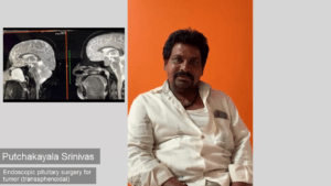Pre and post-op MRI images of patient undergoing transnasal pituitary surgery at Dr Rao's Hospital, Guntur, India.