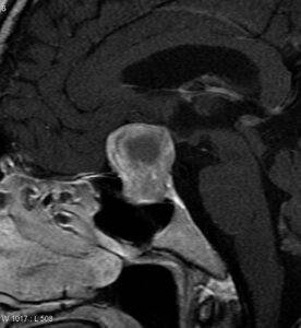 Latest Advancements in Neurosurgery: Dr. Rao at Dr. Rao's Hospital pituitary-macroadenoma